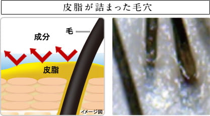 皮脂が詰まった毛穴　成分　毛　皮脂　イメージ図